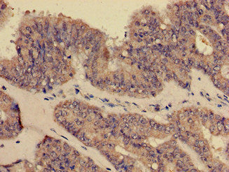 Immunohistochemistry of paraffin-embedded human endometrial cancer using CSB-PA005932EA01HU at dilution of 1:100