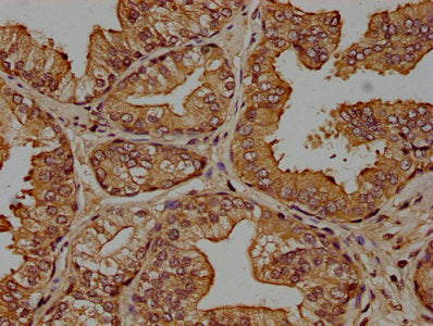 IHC image of CSB-PA005963OA01HU diluted at 1:100 and staining in paraffin-embedded human prostate cancer performed on a Leica BondTM system. After dewaxing and hydration, antigen retrieval was mediated by high pressure in a citrate buffer (pH 6.0)...