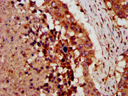 IHC image of CSB-PA005982LA01HU diluted at 1:300 and staining in paraffin-embedded human lung cancer performed on a Leica BondTM system. After dewaxing and hydration, antigen retrieval was mediated by high pressure in a citrate buffer (pH 6.0). Se...