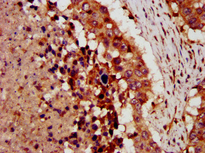 IHC image of CSB-PA005982LA01HU diluted at 1:300 and staining in paraffin-embedded human lung cancer performed on a Leica BondTM system. After dewaxing and hydration, antigen retrieval was mediated by high pressure in a citrate buffer (pH 6.0). Se...