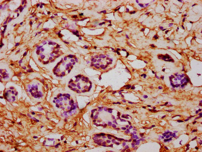 IHC image of CSB-PA006032LA01HU diluted at 1:600 and staining in paraffin-embedded human breast cancer performed on a Leica BondTM system. After dewaxing and hydration, antigen retrieval was mediated by high pressure in a citrate buffer (pH 6.0)....