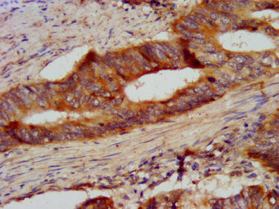 IHC image of CSB-PA006063LA01HU diluted at 1:300 and staining in paraffin-embedded human colon cancer performed on a Leica BondTM system. After dewaxing and hydration, antigen retrieval was mediated by high pressure in a citrate buffer (pH 6.0). S...