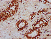 IHC image of CSB-PA006064LA01HU diluted at 1:300 and staining in paraffin-embedded human breast cancer performed on a Leica BondTM system. After dewaxing and hydration, antigen retrieval was mediated by high pressure in a citrate buffer (pH 6.0)....