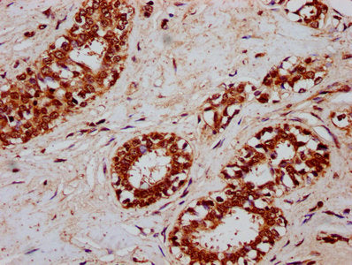 IHC image of CSB-PA006064LA01HU diluted at 1:300 and staining in paraffin-embedded human breast cancer performed on a Leica BondTM system. After dewaxing and hydration, antigen retrieval was mediated by high pressure in a citrate buffer (pH 6.0)....