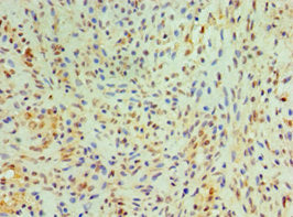 Immunohistochemistry of paraffin-embedded human breast cancer using CSB-PA006092ESR2HU at dilution of 1:100