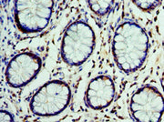Immunohistochemistry of paraffin-embedded human colon cancer using CSB-PA006095ESR2HU at dilution of 1:100