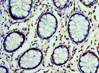 Immunohistochemistry of paraffin-embedded human colon cancer using CSB-PA006095ESR2HU at dilution of 1:100