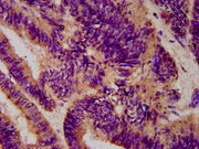 IHC image of CSB-PA006131LA01HU diluted at 1:600 and staining in paraffin-embedded human colon cancer performed on a Leica BondTM system. After dewaxing and hydration, antigen retrieval was mediated by high pressure in a citrate buffer (pH 6.0). S...