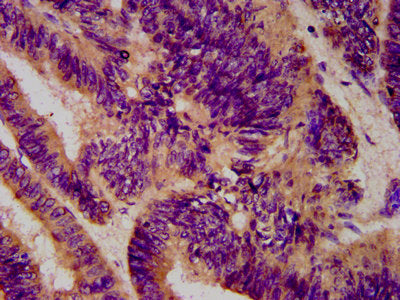 IHC image of CSB-PA006131LA01HU diluted at 1:600 and staining in paraffin-embedded human colon cancer performed on a Leica BondTM system. After dewaxing and hydration, antigen retrieval was mediated by high pressure in a citrate buffer (pH 6.0). S...