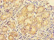 Immunohistochemistry of paraffin-embedded human gastric cancer using CSB-PA006188LA01HU at dilution of 1:100