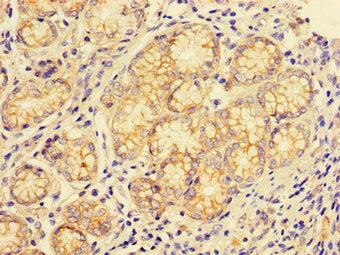Immunohistochemistry of paraffin-embedded human gastric cancer using CSB-PA006188LA01HU at dilution of 1:100