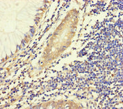 Immunohistochemistry of paraffin-embedded human colon cancer using CSB-PA006268LA01HU at dilution of 1:100