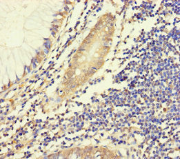 Immunohistochemistry of paraffin-embedded human colon cancer using CSB-PA006268LA01HU at dilution of 1:100