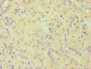 Immunohistochemistry of paraffin-embedded human liver cancer using CSB-PA006376ESR2HU at dilution of 1:100