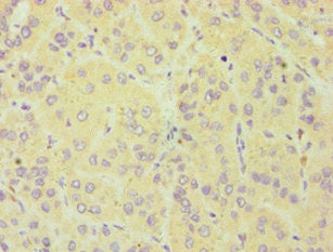 Immunohistochemistry of paraffin-embedded human liver cancer using CSB-PA006376ESR2HU at dilution of 1:100