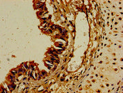 Immunohistochemistry of paraffin-embedded human colon cancer using CSB-PA006395LA01HU at dilution of 1:100