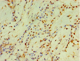 Immunohistochemistry of paraffin-embedded human breast cancer using CSB-PA006430ESR1HU at dilution of 1:100