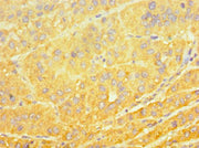 Immunohistochemistry of paraffin-embedded human liver cancer using CSB-PA006446ESR1HU at dilution of 1:100