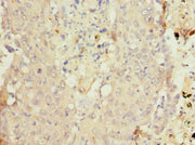 Immunohistochemistry of paraffin-embedded human lung cancer using CSB-PA006448ESR1HU at dilution of 1:100