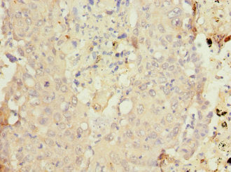 Immunohistochemistry of paraffin-embedded human lung cancer using CSB-PA006448ESR1HU at dilution of 1:100