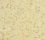 Immunohistochemistry of paraffin-embedded human glioma using CSB-PA006519HA01HU at dilution of 1:100