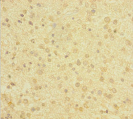 Immunohistochemistry of paraffin-embedded human glioma using CSB-PA006519HA01HU at dilution of 1:100