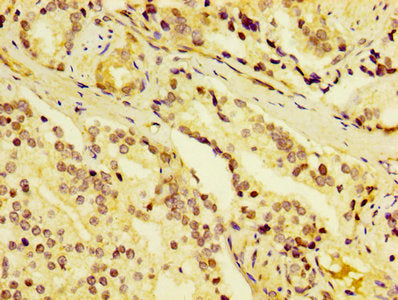 IHC image of CSB-PA006537DA01HU diluted at 1:400 and staining in paraffin-embedded human prostate cancer performed on a Leica BondTM system. After dewaxing and hydration, antigen retrieval was mediated by high pressure in a citrate buffer (pH 6.0)...