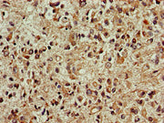 Immunohistochemistry of paraffin-embedded human glioma using CSB-PA006547LA01HU at dilution of 1:100