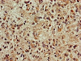 Immunohistochemistry of paraffin-embedded human glioma using CSB-PA006547LA01HU at dilution of 1:100