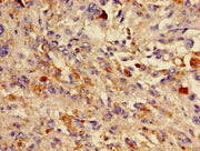 Immunohistochemistry of paraffin-embedded human melanoma using CSB-PA006562LA01HU at dilution of 1:100