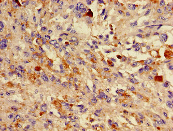 Immunohistochemistry of paraffin-embedded human melanoma using CSB-PA006562LA01HU at dilution of 1:100