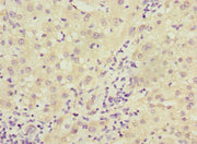 Immunohistochemistry of paraffin-embedded human liver cancer using CSB-PA006563ESR2HU at dilution of 1:100
