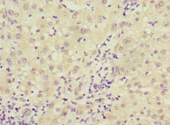 Immunohistochemistry of paraffin-embedded human liver cancer using CSB-PA006563ESR2HU at dilution of 1:100