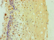 Immunohistochemistry of paraffin-embedded human cervical cancer using CSB-PA006621DSR2HU at dilution of 1:100