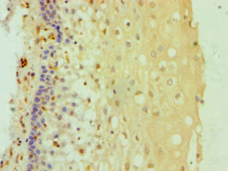 Immunohistochemistry of paraffin-embedded human cervical cancer using CSB-PA006621DSR2HU at dilution of 1:100