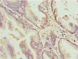 Immunohistochemistry of paraffin-embedded human prostate cancer using CSB-PA006648ESR2HU at dilution of 1:100