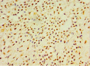 Immunohistochemistry of paraffin-embedded human breast cancer using CSB-PA006705ESR1HU at dilution of 1:100