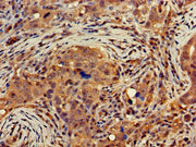 Immunohistochemistry of paraffin-embedded human pancreatic cancer using CSB-PA006817LA01HU at dilution of 1:100