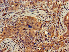 Immunohistochemistry of paraffin-embedded human pancreatic cancer using CSB-PA006817LA01HU at dilution of 1:100