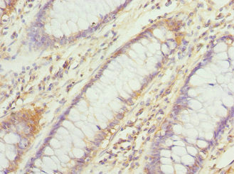 Immunohistochemistry of paraffin-embedded human colon cancer using CSB-PA006845ESR2HU at dilution of 1:100