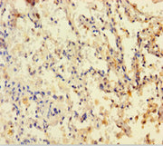 Immunohistochemistry of paraffin-embedded human lung cancer using CSB-PA006847HA01HU at dilution of 1:100