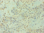 Immunohistochemistry of paraffin-embedded human breast cancer using CSB-PA006907ESR2HU at dilution of 1:100