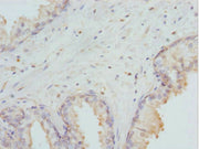Immunohistochemistry of paraffin-embedded human prostate cancer using CSB-PA006953DSR2HU at dilution of 1:100