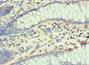 Immunohistochemistry of paraffin-embedded human colon cancer using CSB-PA006954ESR2HU at dilution of 1:100