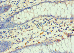 Immunohistochemistry of paraffin-embedded human colon cancer using CSB-PA006954ESR2HU at dilution of 1:100
