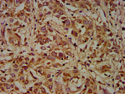 IHC image of CSB-PA006963LA01HU diluted at 1:200 and staining in paraffin-embedded human liver cancer performed on a Leica BondTM system. After dewaxing and hydration, antigen retrieval was mediated by high pressure in a citrate buffer (pH 6.0). S...