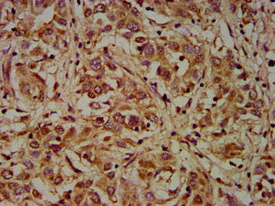 IHC image of CSB-PA006963LA01HU diluted at 1:200 and staining in paraffin-embedded human liver cancer performed on a Leica BondTM system. After dewaxing and hydration, antigen retrieval was mediated by high pressure in a citrate buffer (pH 6.0). S...