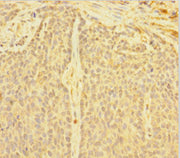 Immunohistochemistry of paraffin-embedded human ovarian cancer using CSB-PA007089LA01HU at dilution of 1:100