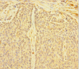Immunohistochemistry of paraffin-embedded human ovarian cancer using CSB-PA007089LA01HU at dilution of 1:100