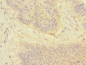 Immunohistochemistry of paraffin-embedded human colon cancer using CSB-PA007189ESR1HU at dilution of 1:100